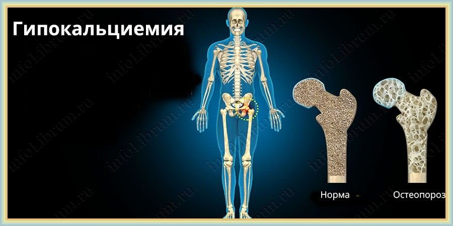 Снижение уровня кальция в плазме крови ниже 1,87 ммоль/л называется гипокальциемией. Нормальный уровень кальция находится в пределах 2,2 – 2,5 ммоль/л. Его содержание в клетках превышает уровень во вмежклеточном пространстве во много раз.