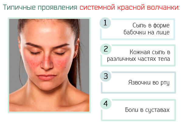 Типичные проявления СКВ