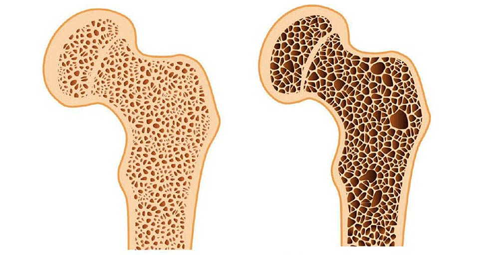 Деградация кости при остеопорозе