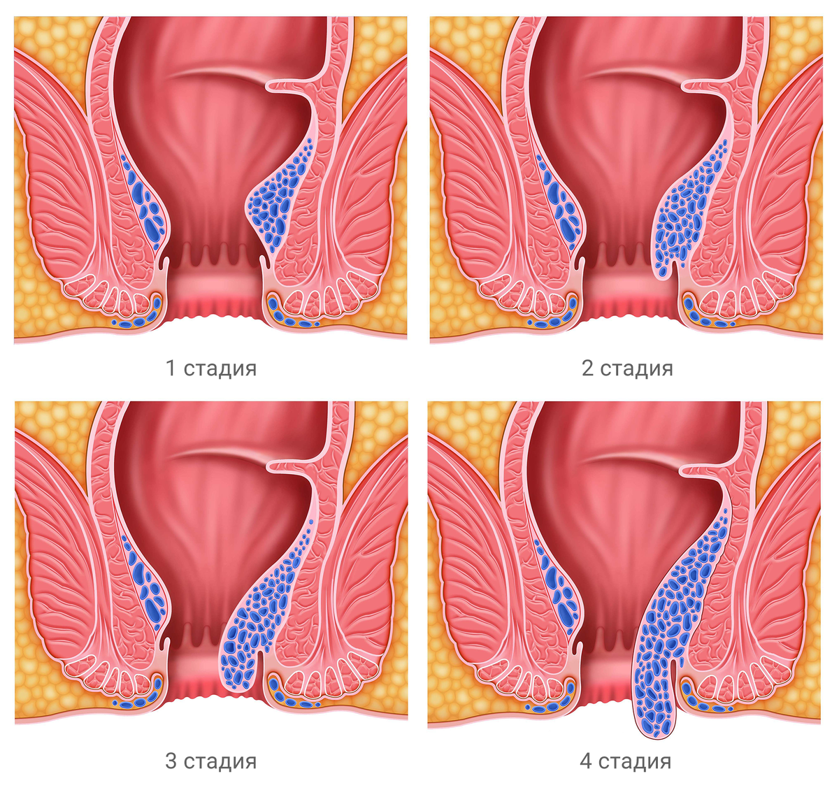 Paraproctitis is acute and chronic. Symptoms Treatment. Photo