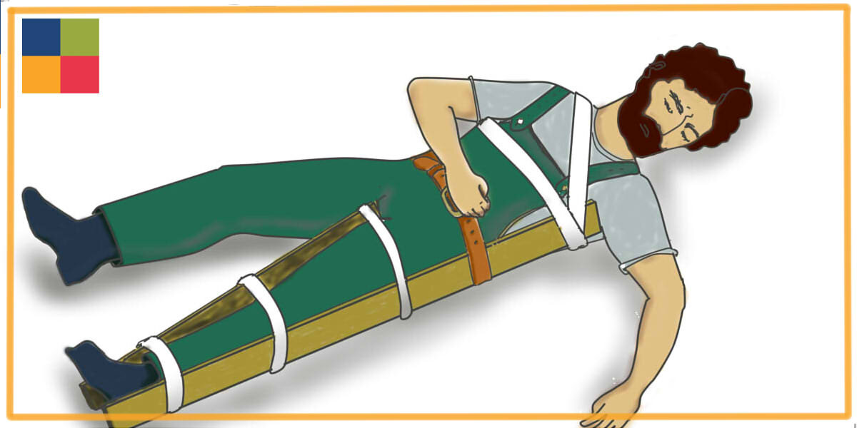 Наложение шины при переломе бедра: фиксируются три сустава - голеностопный, коленный и бедренный.