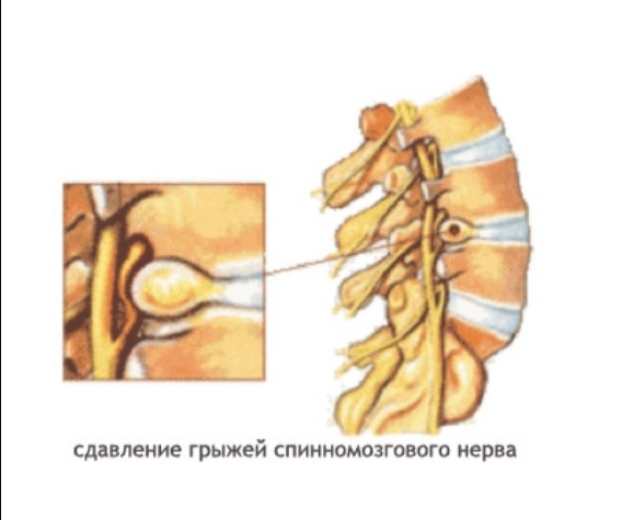 Фото автора. Осложнение остеохондроза позвоночника - грыжа межпозвоночного диска
