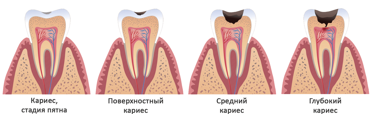 Стадии развития кариеса, картинка из свободных источников.