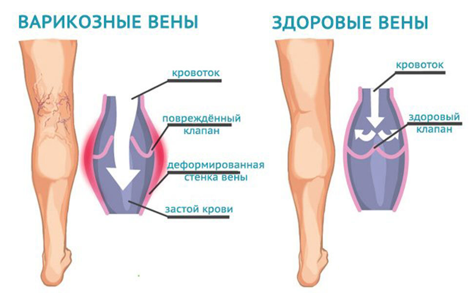 Причины возникновения и методы устранения неприятного запаха ног