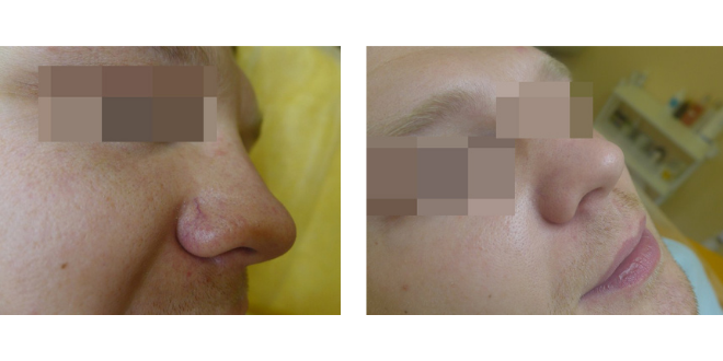 ДО и ПОСЛЕ процедуры