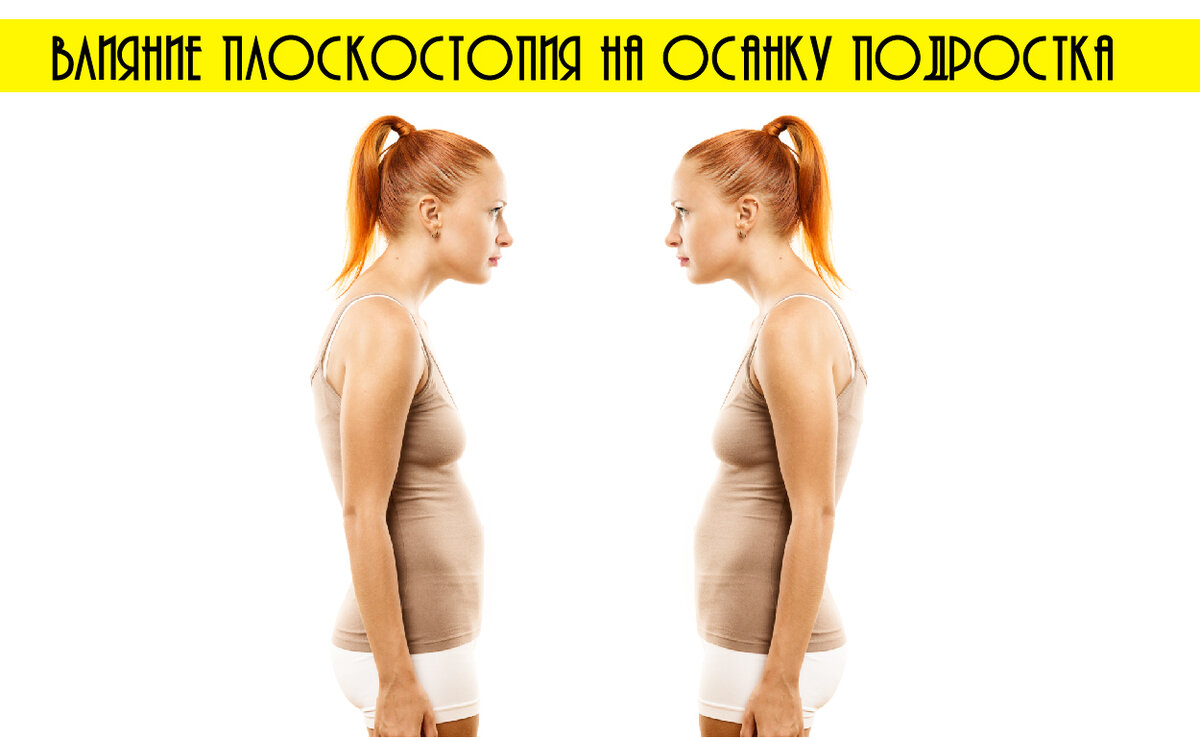 влияние плоскостопия на осанку подростка