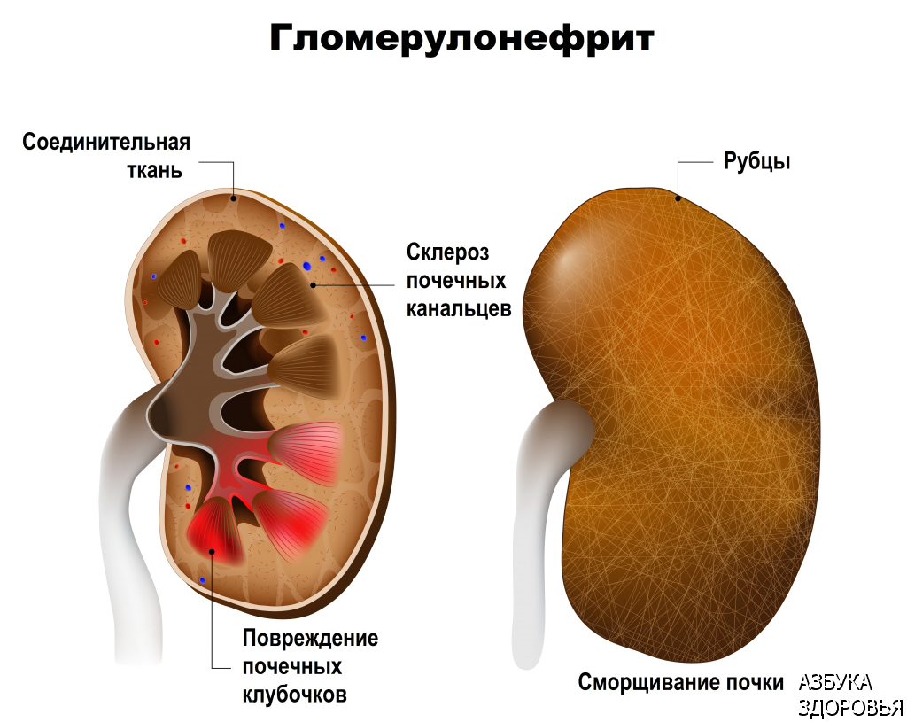 Гломерулонефр