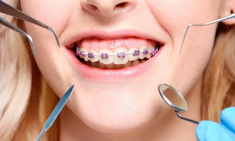 Брекеты в ортодонтическом лечении