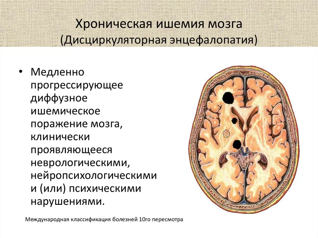 Хигм это. Дисциркуляторная энцефалопатия головного мозга. Хроническая ишемия головного мозга симптомы. Шинамия головного мозга. Ишемическое поражение мозга