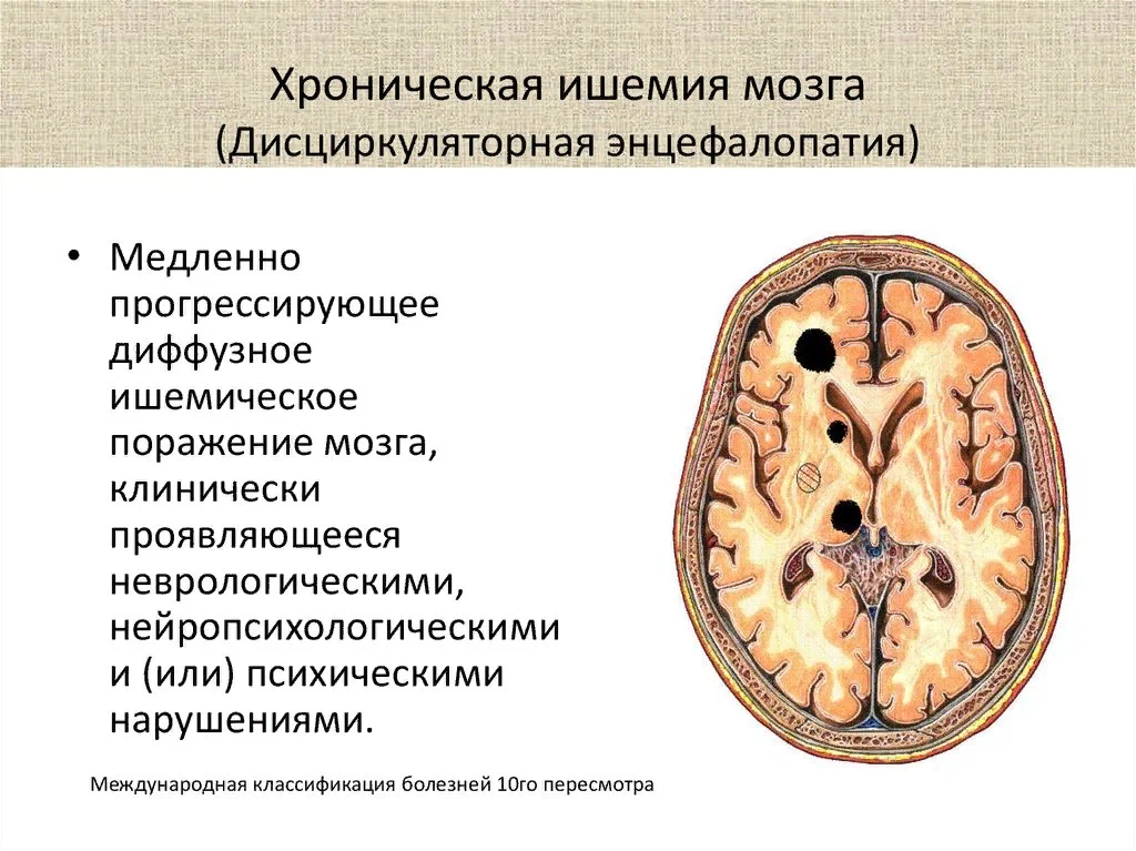 Что такое ишемия головного мозга. Ишемическая болезнь головного. Классификация ишемии головного мозга. Хроническая ишемия головного. Хроническая ишемия головного мозгах.