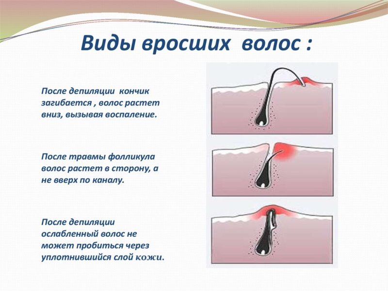 Как избавиться от вросших волос после эпиляции