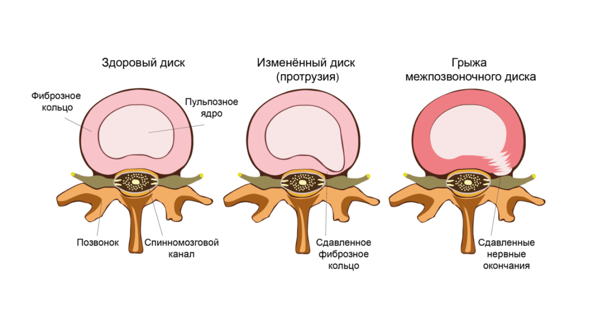 Виды протрузий дисков. Пульпозное ядро межпозвоночного диска. Грыжа дисков позвоночника. Грыжа межпозвоночного диска разрыв фиброзного кольца. Фиброзное кольцо и пульпозное ядро.
