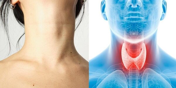 Cum să îmbunătățiți funcționarea glandei tiroide fără medicamente