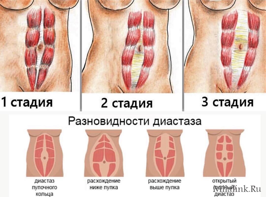 СТАДИИ зависят от глубины нарушений натяжений по телу
РАЗНОВИДНОСТИ обусловлены тем, какие и как цепи нарушены