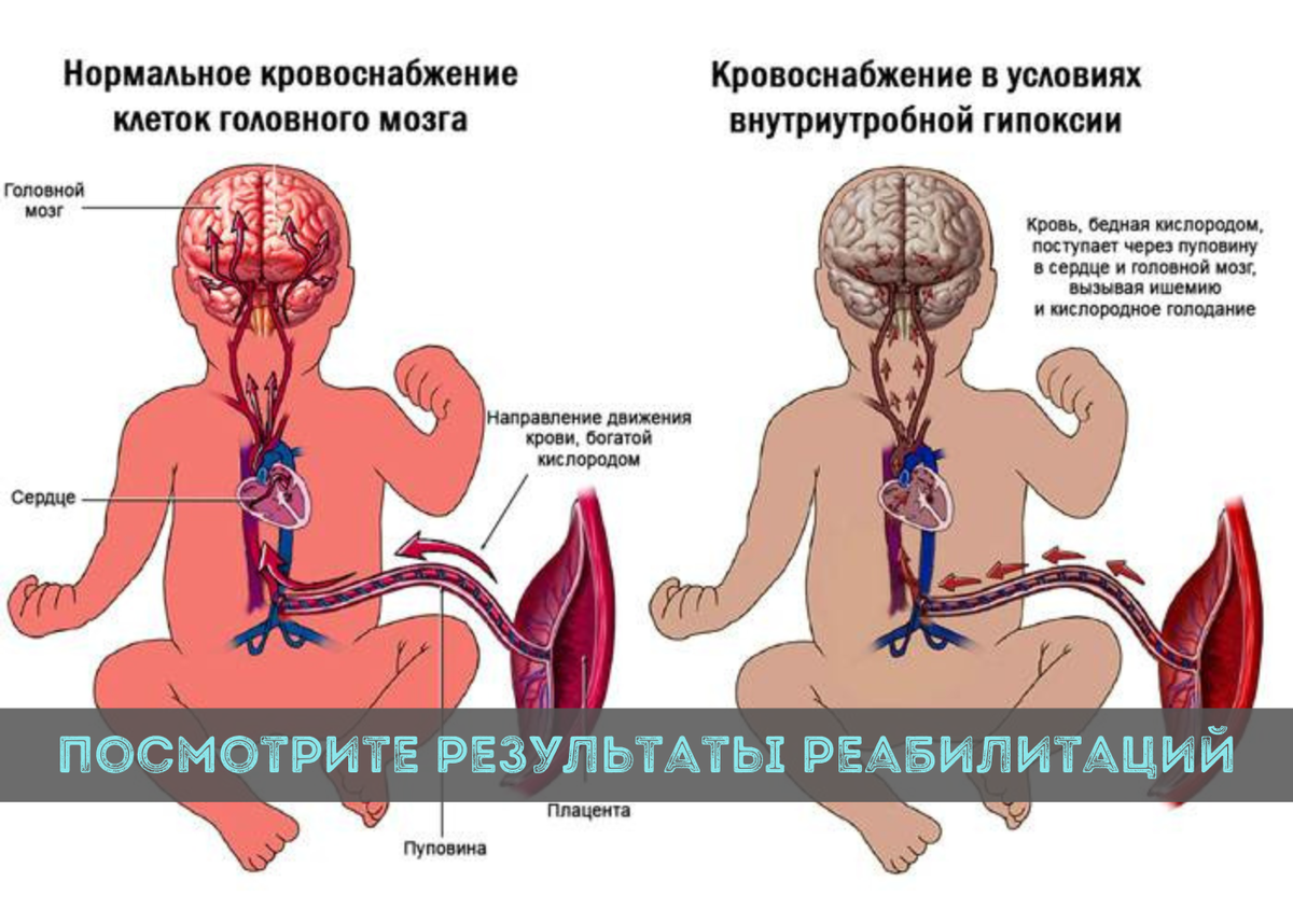 Гипоксия мозга у ребенка