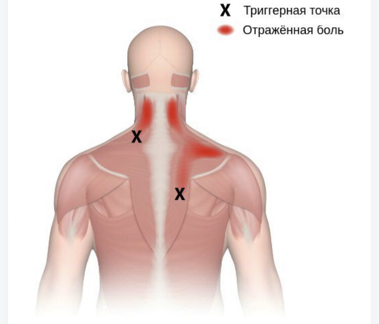 Миофасциальный синдром шейного отдела симптомы. Средоточие боли Trigger point 2021.