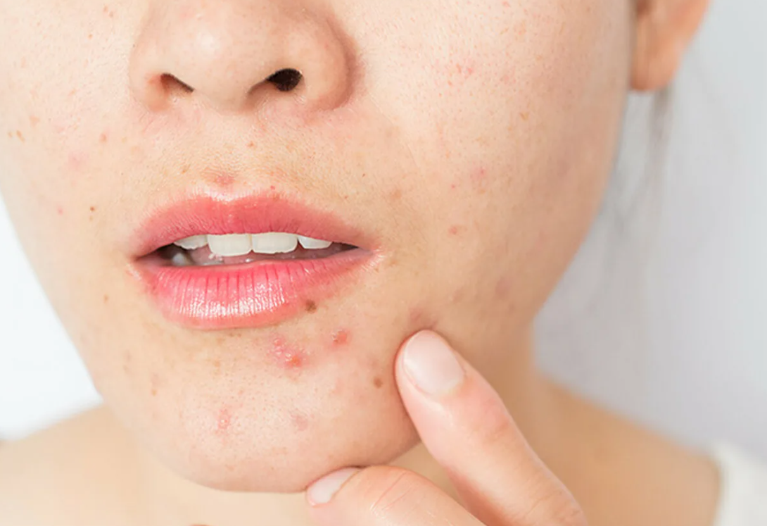 Топикальные препараты для лечения акне