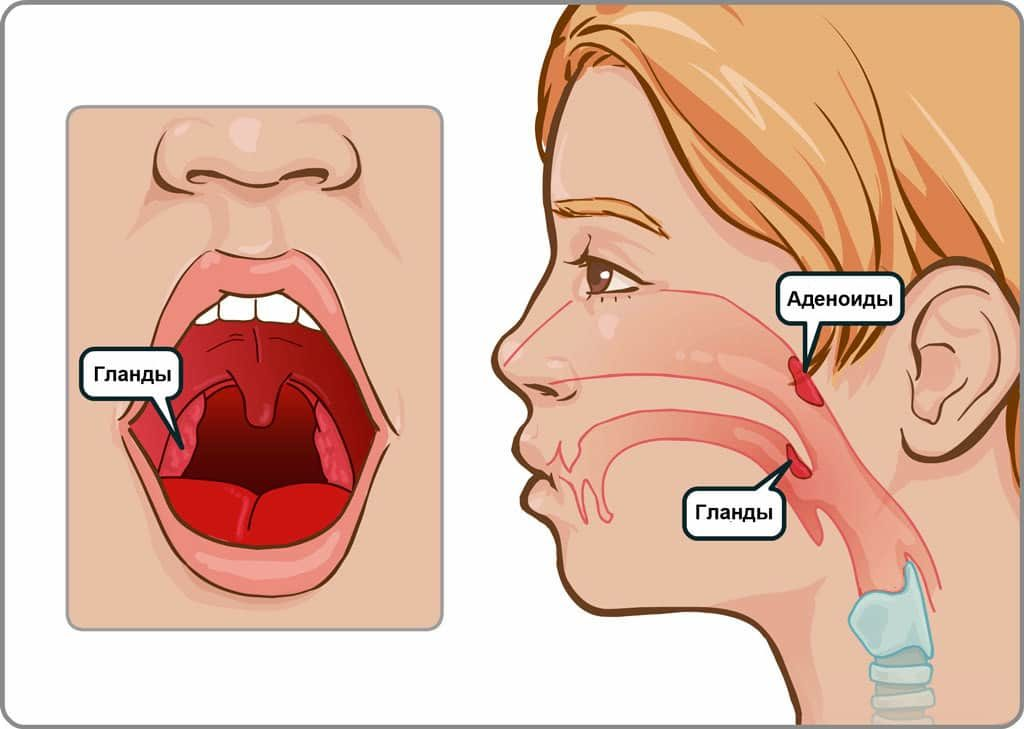 Открытыми рот нос и. Аденоиды носоглоточные миндалины. Гланды аденоиды миндалины что это.