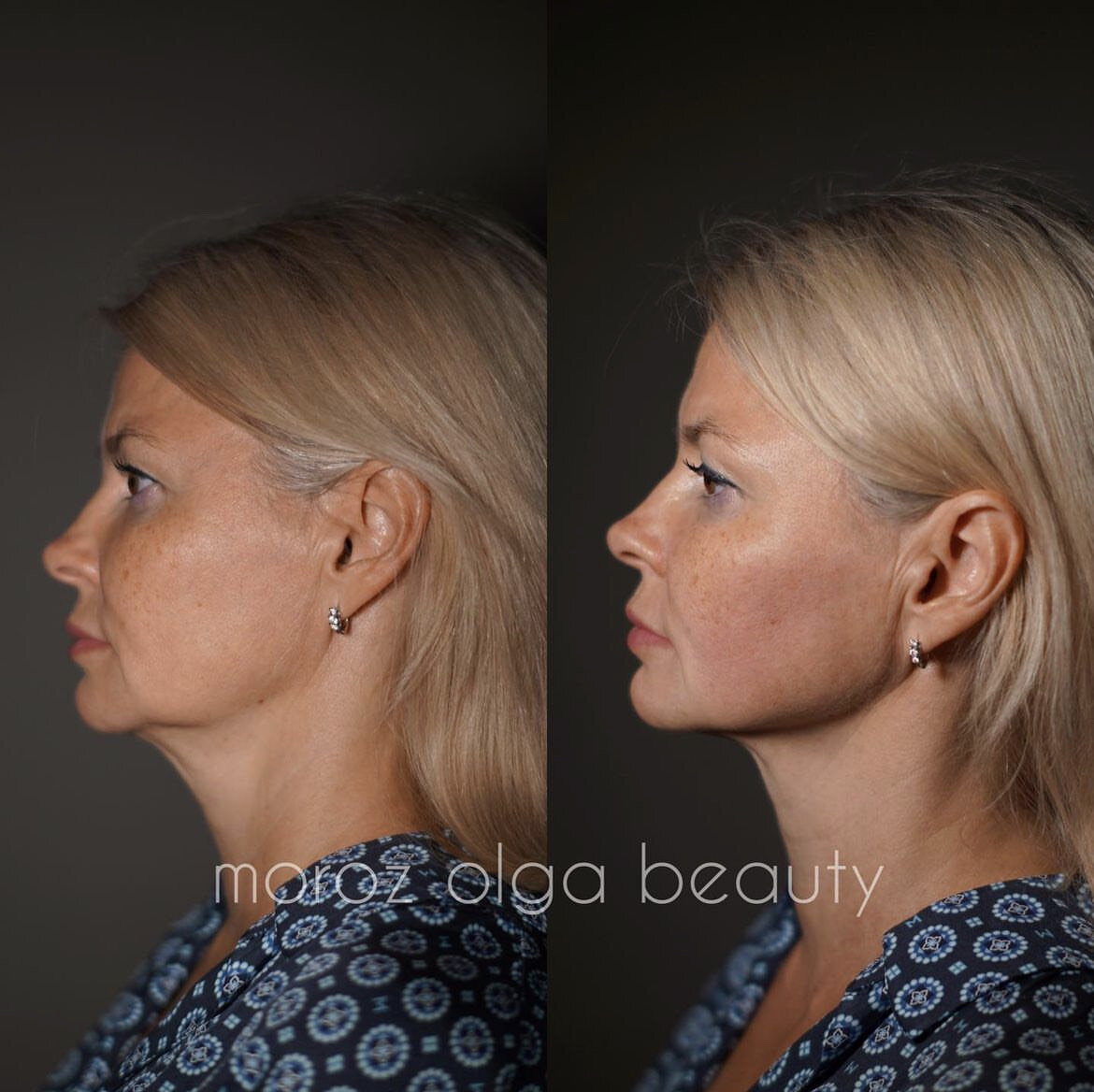 Бывает так, что уже совсем скоро  предстоит ответственная встреча или торжественное мероприятие, и надо срочно выглядеть «на все 100». Во многих клиниках можно прочесть – процедура  «для красной  дорожки».  Мы приготовили для вас методику, которая хорошо известна под названием «Стройное лицо», и это не только для красной дорожки, но и для мощного лифтинг эффекта.