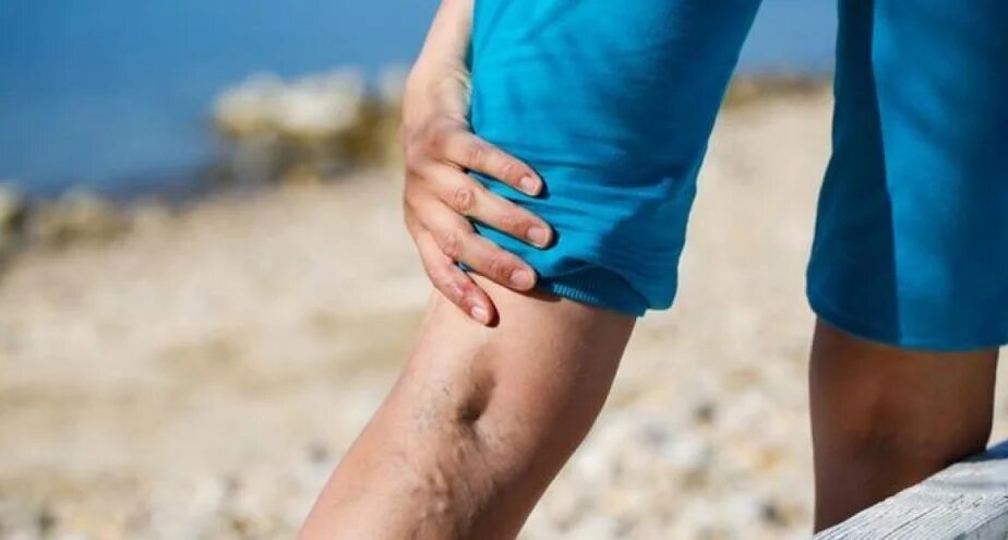 запущенное  Как вылечить варикоз? варикозное расширение вен ;