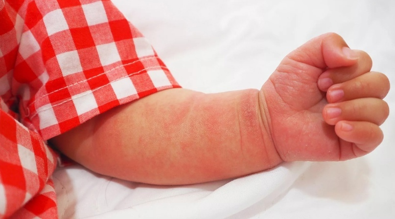 Пример аллергической реакции