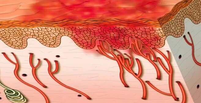 Что такое васкулит? В чём опасность васкулита