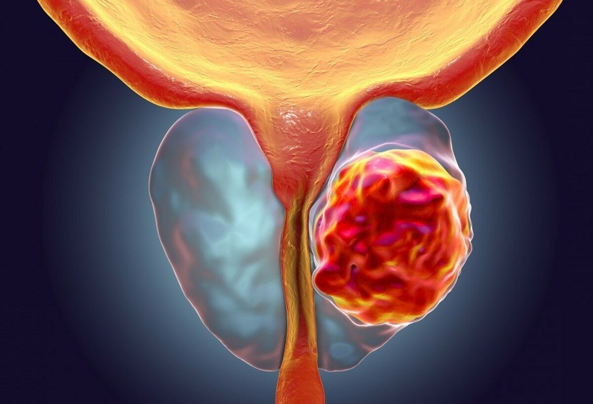 Разработан новый эффективный препарат против рака простаты | ОФАРМЕ.РФ |  Дзен