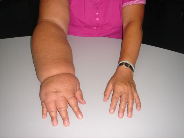 Воспаление сухожилия кисти руки: симптомы, лечение, профилактика