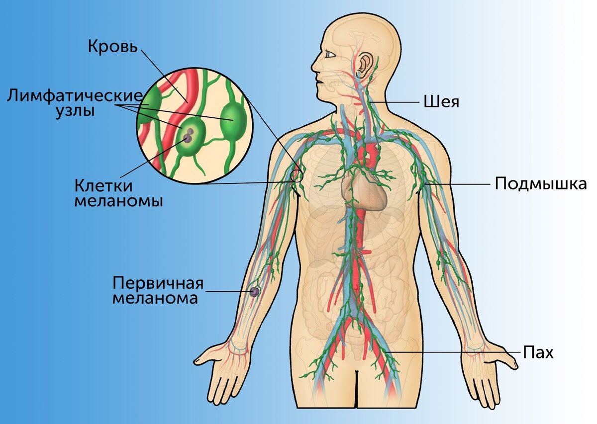 Метастазы есть, а опухоли нет, как такое может быть? | Международная  клиника MEDICA24 | Дзен