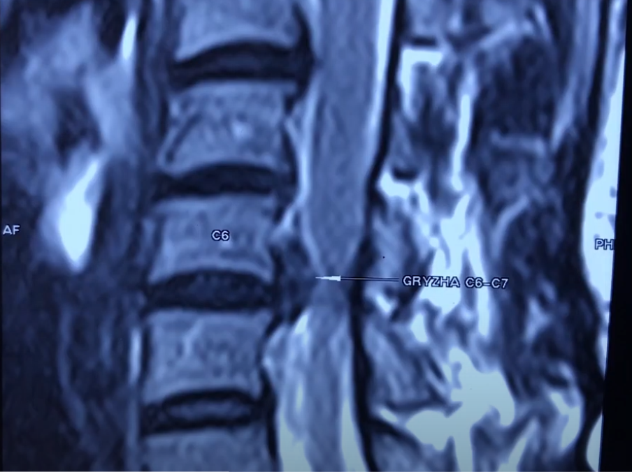 Грыжа на уровне C6-C7