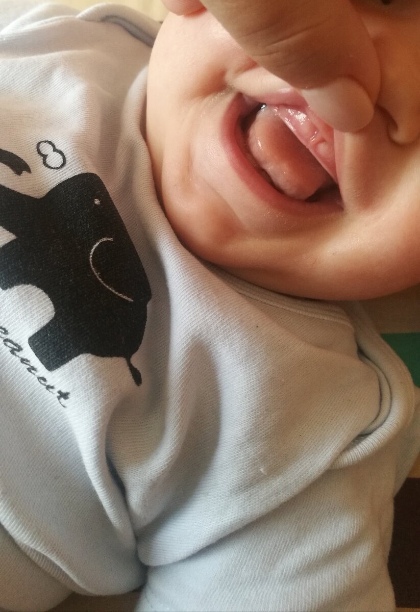 Будущий зубастик. Припухшая верхняя десна.