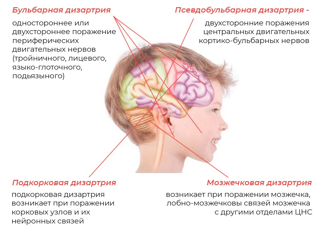 Что значит дизартрия. Экстрапирамидная дизартрия. мозжечковая дизартрия. дизартрия картинки. дизартрия картинки для презентации.