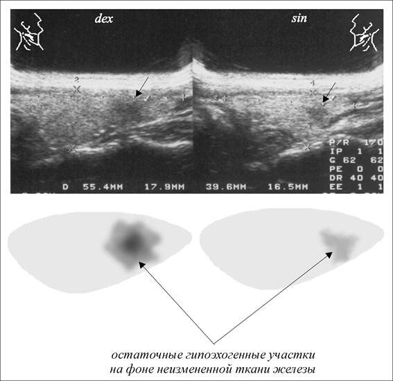 Щитовидная железа аит узи