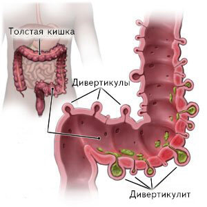 Так выглядит дивертикулез - множественные дивертикулы
