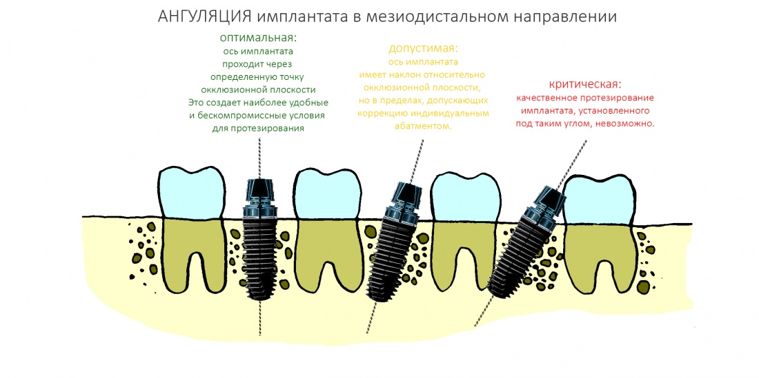 На картинке изображено правильное (крайний левый имплант) и не правильное (крайний правый имплант и посередине) положение импланта. В случае с левым положением использовали шаблон, в случае с правым и посередине - нет.