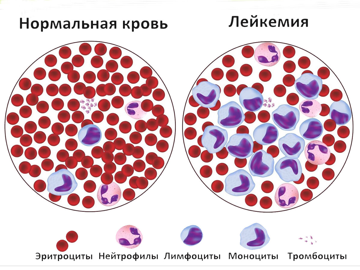 Первые признаки лейкоза | ПульсПлюс | Дзен