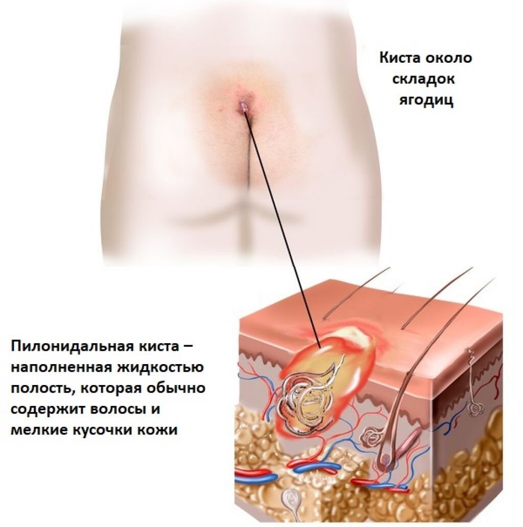 Дермоидная киста