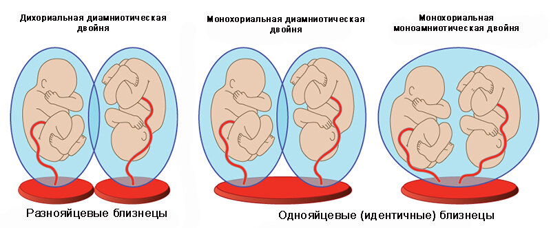 Как протекает беременность двойней