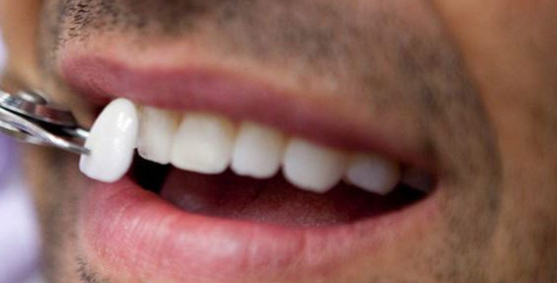 Именно так выглядит винир