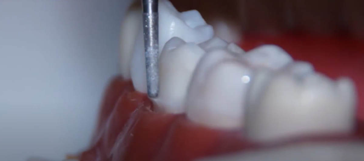 Обточка зуба 