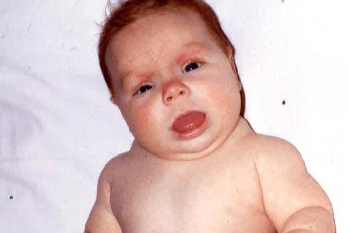 вот так это выглядит: апатичное лицо, отёки, большой язык. желтушность.