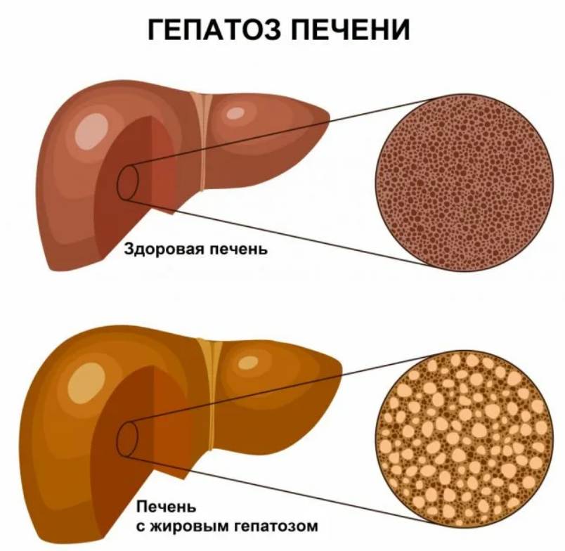 Ожирение печени лечение у мужчин