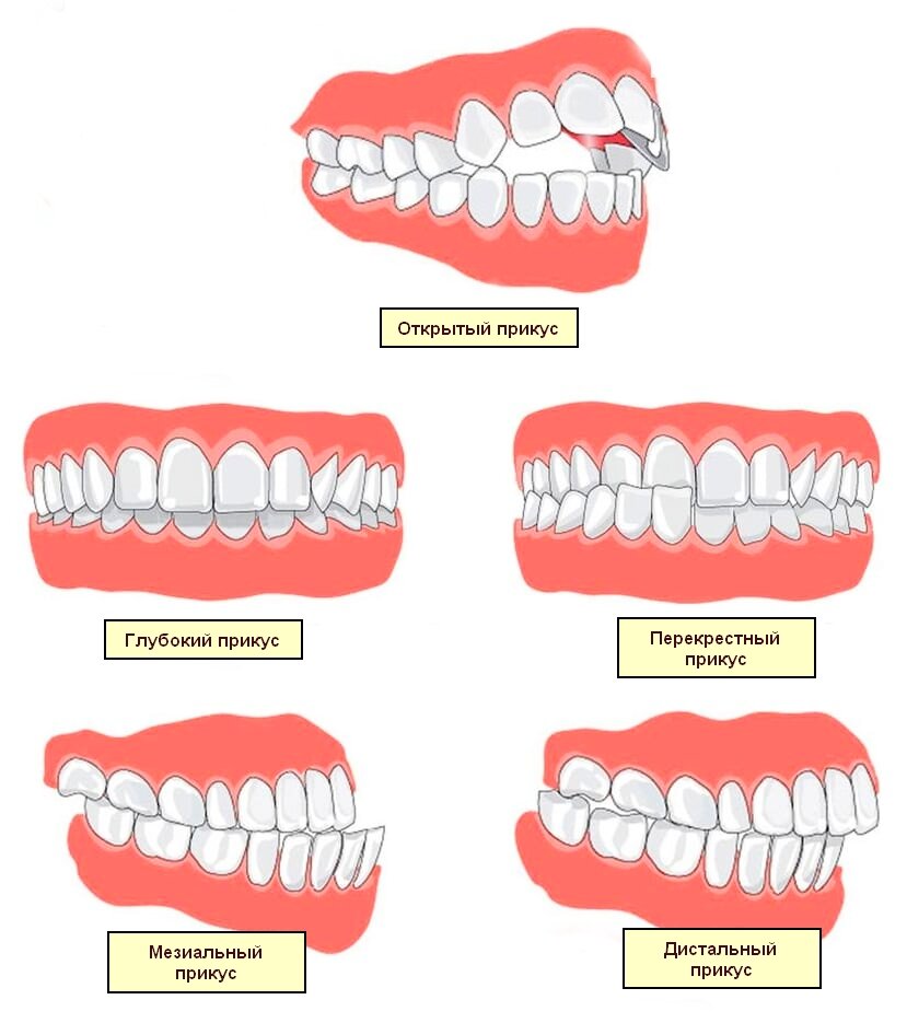 Прикус это. Дистальный перекрестный прикус. Дистальный прикус ортотик. Перекрестный прикус на нижней челюсти. Правильный прикус зубов смыкание зубов.