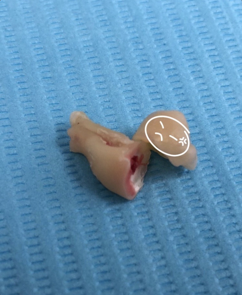 скол коронки