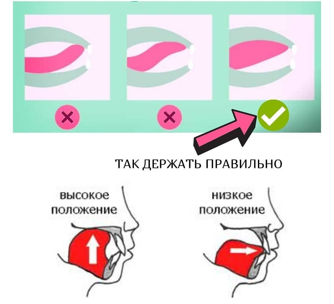 Мюинг положение языка схема