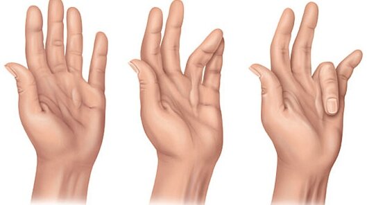 Три степени поражения ладонного апоневроза при контрактуре Дюпюитрена