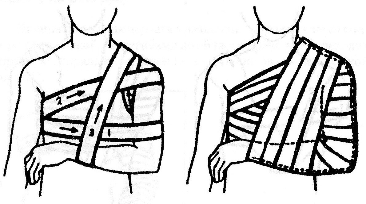 Схема одевания бандажа на плечо