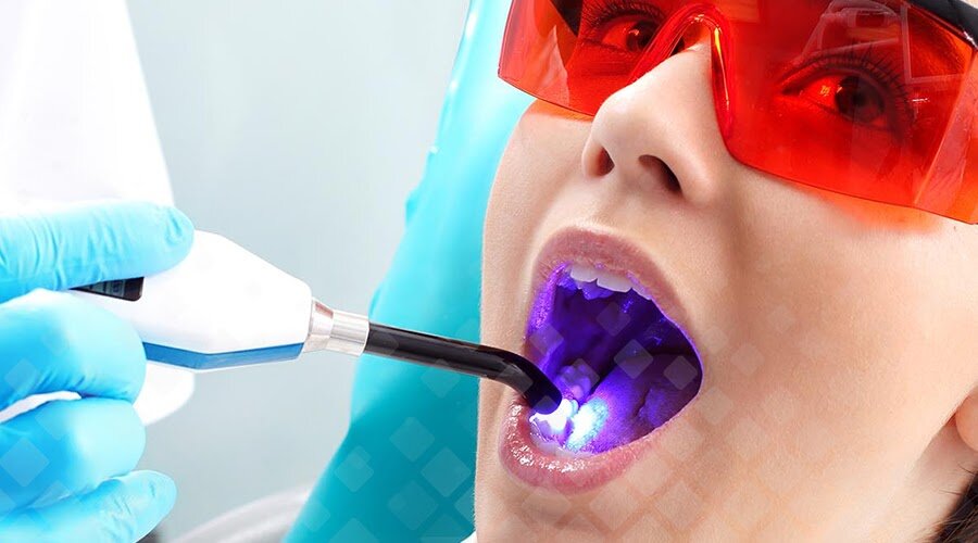 Процесс воздействия ультрафиолетом на светоотверждаемую пломбу. Фото: Яндекс.Картинки.