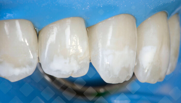 С белым цветом редко ассоциируют опасность. Однако любые изменения оттенка зубов сигнализируют о проблемах. Фото: Яндекс.Картинки.