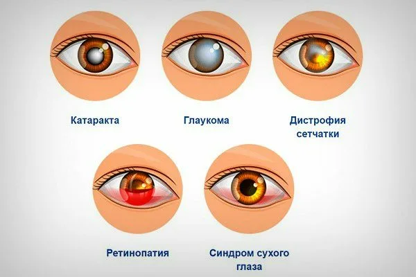 Глаукома глаза что. Глазные болезни: глаукома, катаракта. Катаракта схема глаза. Глаукома и катаракта отличия. Глаукома и здоровый глаз.